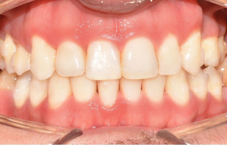 Dr. Betül BALLI DEMİREL 7 invisaling bbd after Dr. Betül BALLI DEMİREL