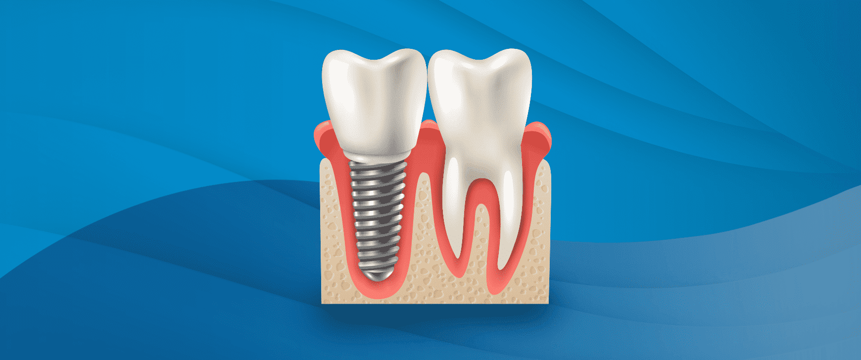 IMPLANT TEDavisi 2 Наши процедуры