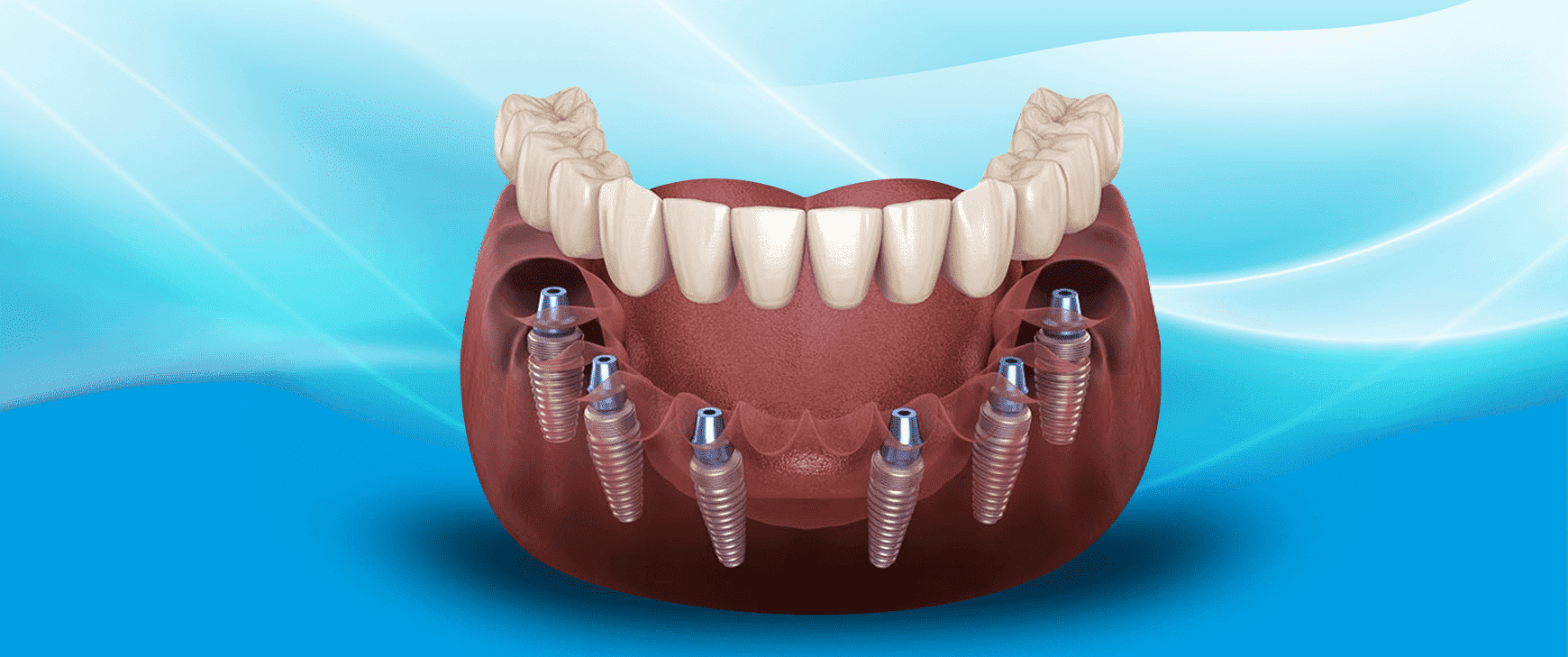 all on six 3 Dental Group Hospitadent - Dental Hospitals