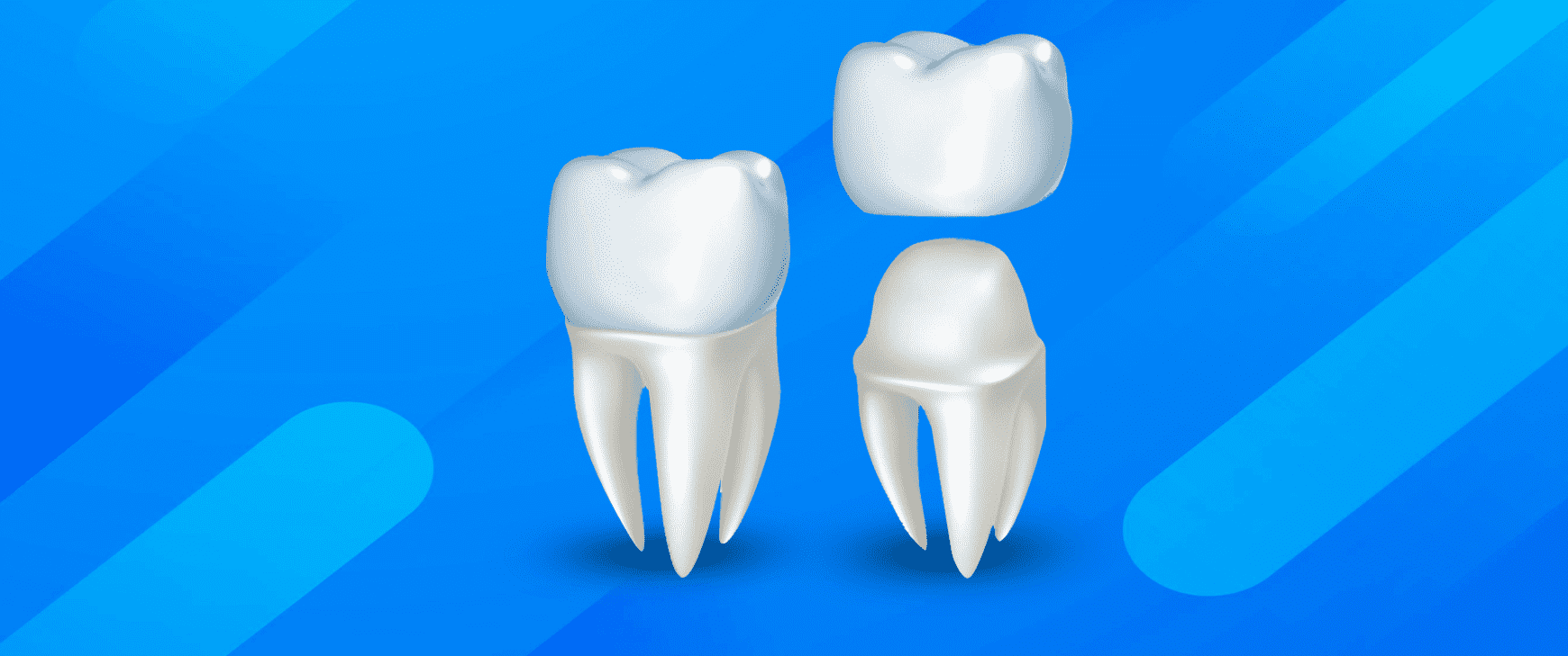 Couronne dentaire - Restauration tout céramique - Dentiste Hardricourt