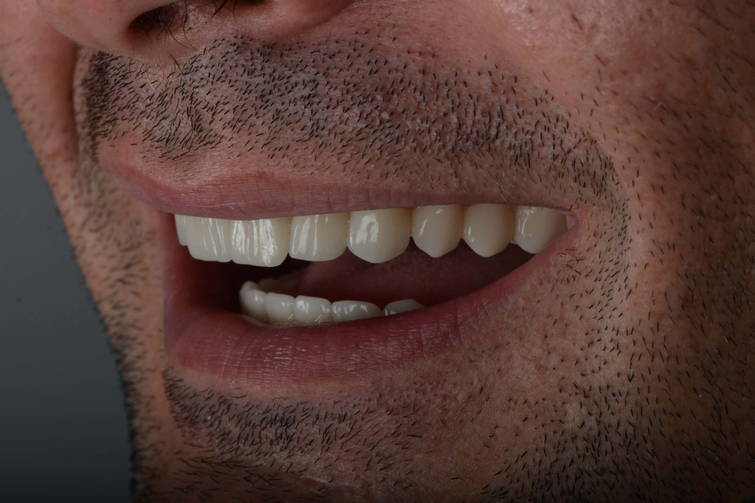 after cerec scaled Dt. Ömer KADIOĞLU