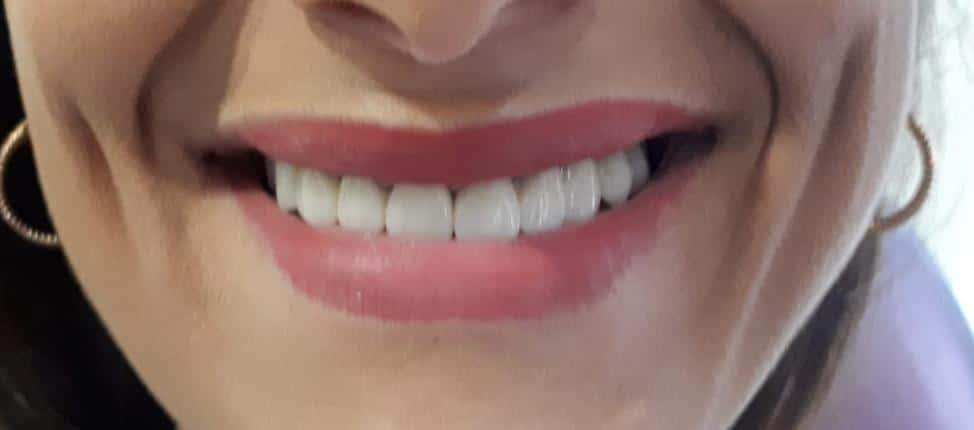 after full zirconium teeth Dt. Gözde ŞEHİRLİ GÜLERER