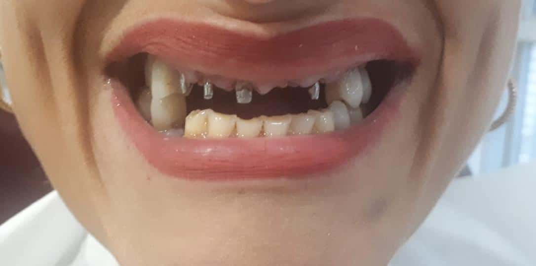 before full zirconium teeth Dt. Gözde ŞEHİRLİ GÜLERER