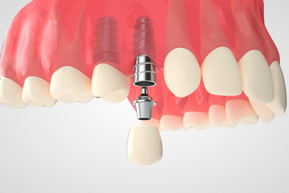 dental implantlar