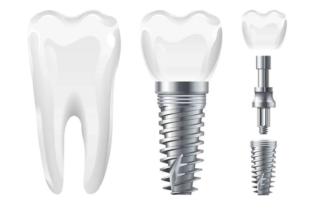 implant markaları