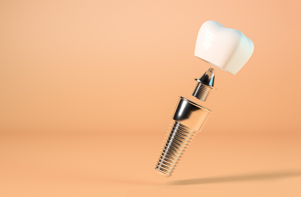 implant uygulamasının yararları