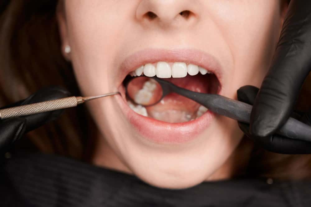 Diş Kaplama Nasıl Yapılır? Çeşitleri Nelerdir?