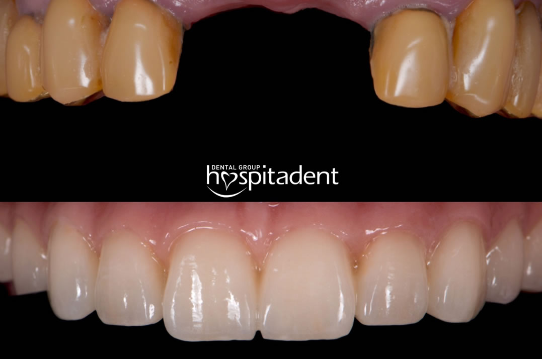 best quality implant