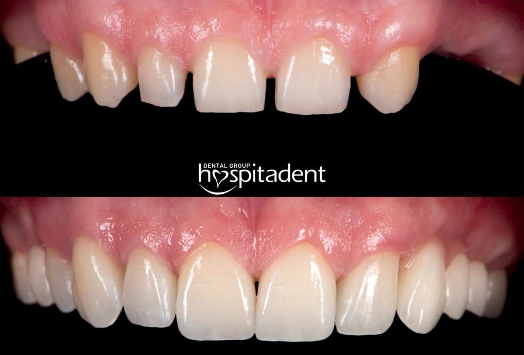 dental implants turkey