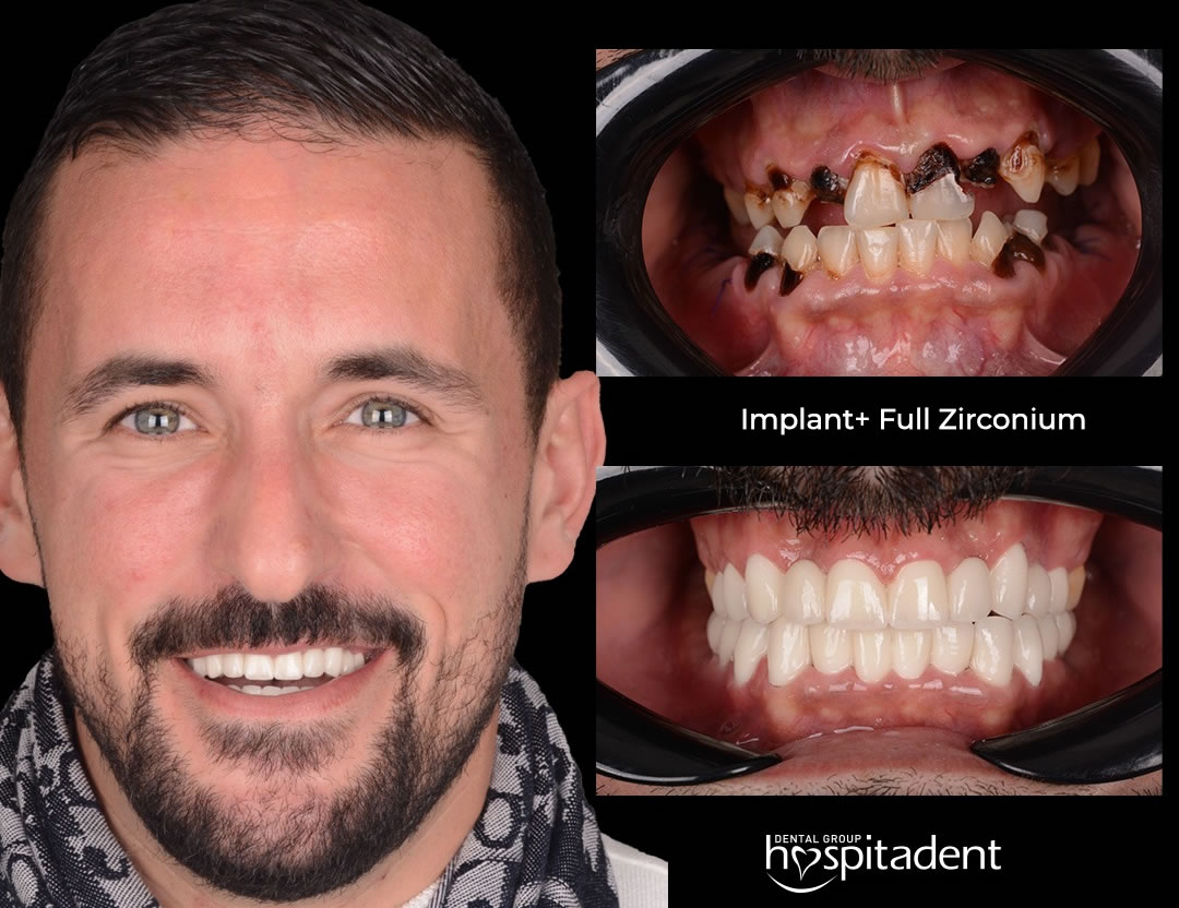 tooth implant turkey