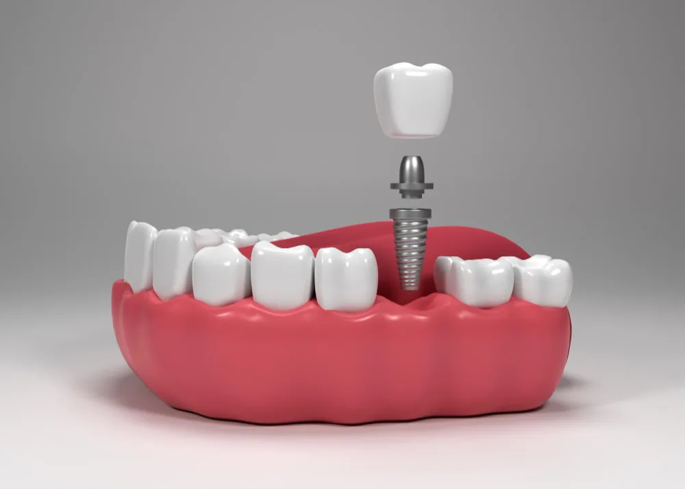 implant tedavileri