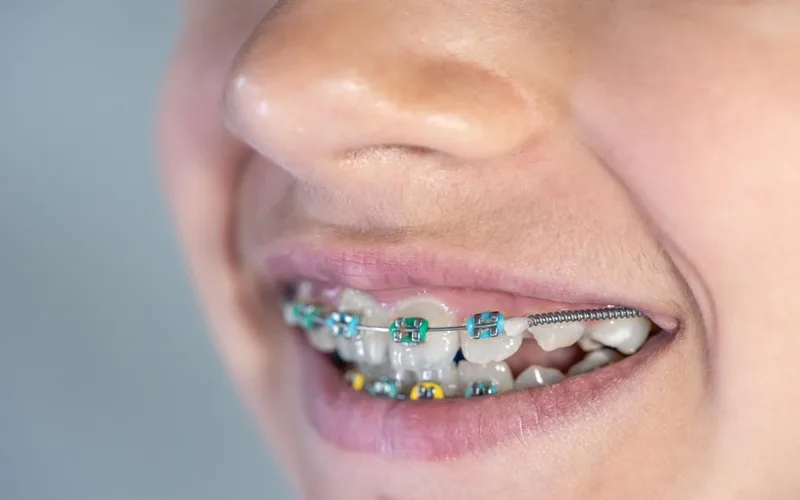 crooked teeth with braces