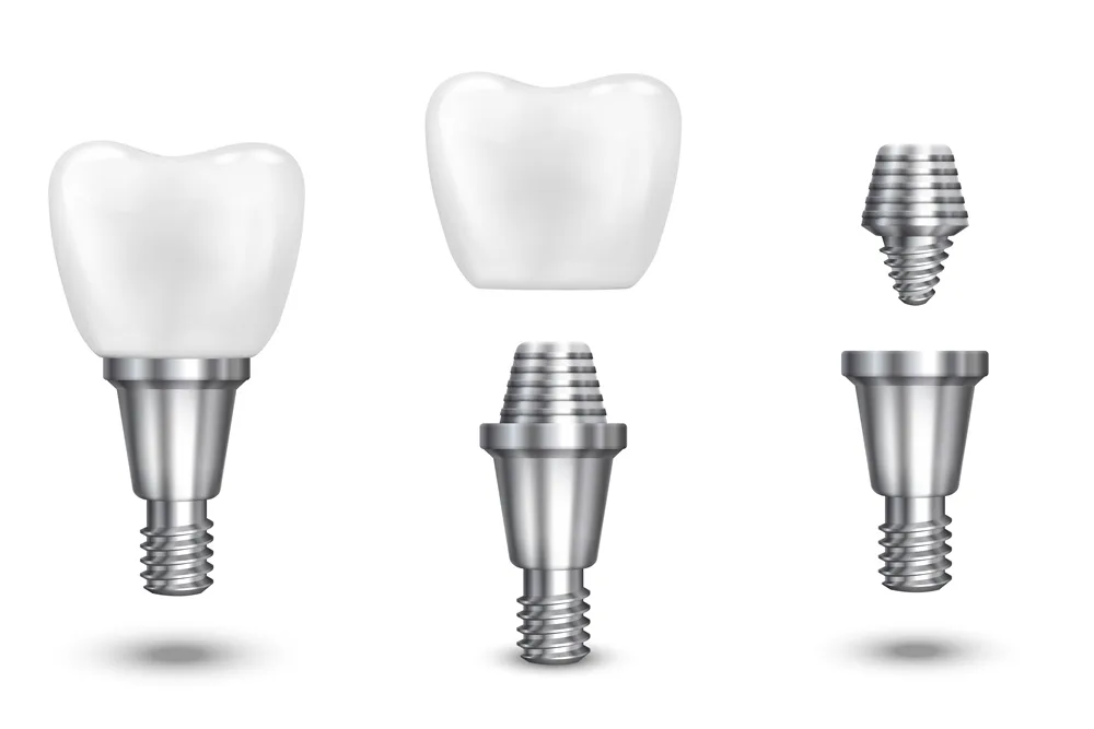 What Makes BioHorizons Implants Stand Out? 2 biohorizons implant
