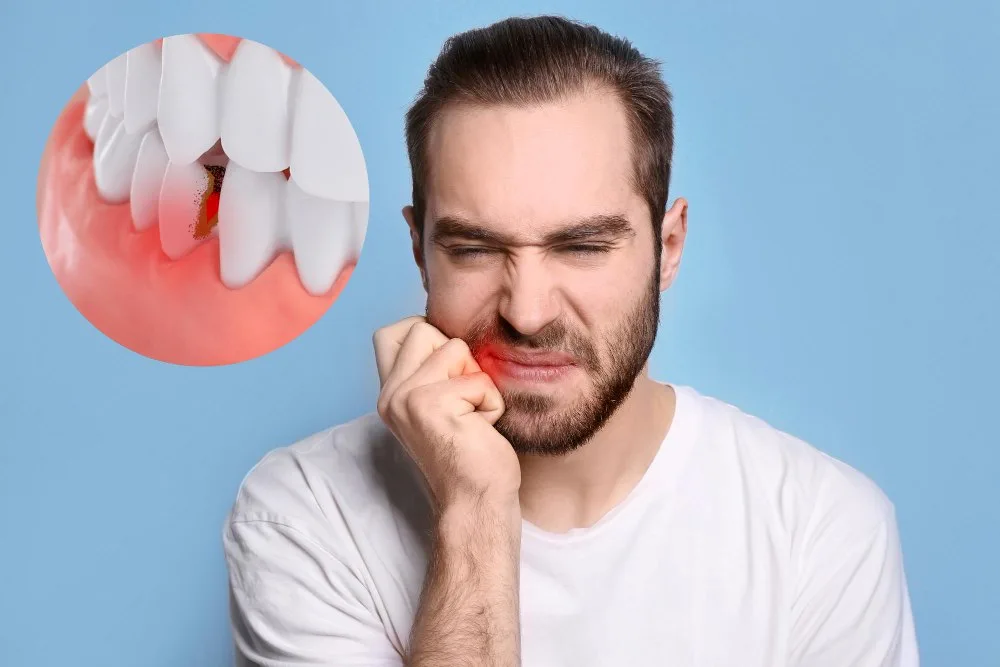 calculus on teeth