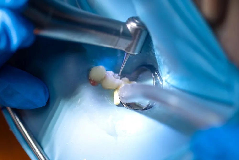dental amalgam fillings