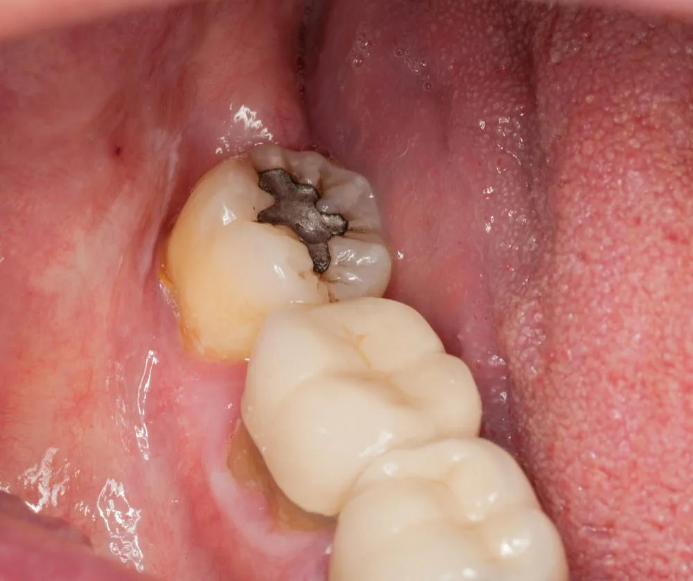 dental amalgam