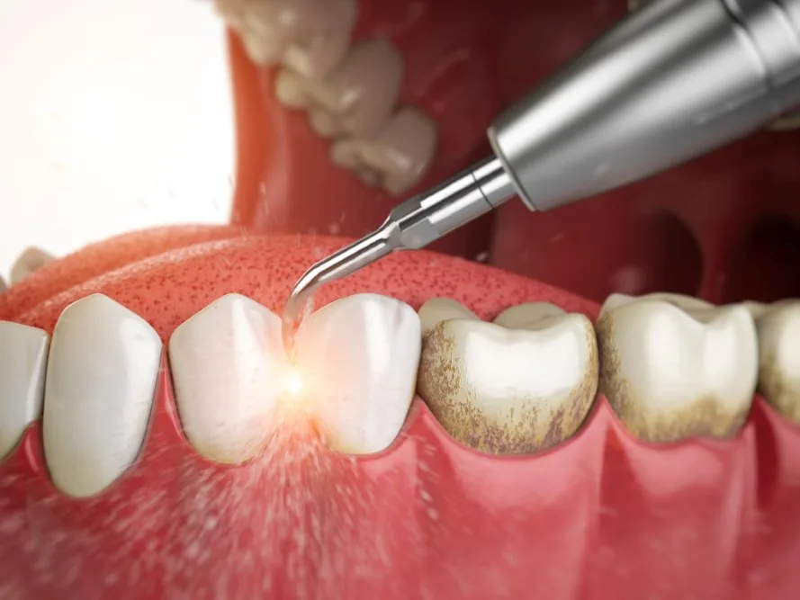 dental tartar