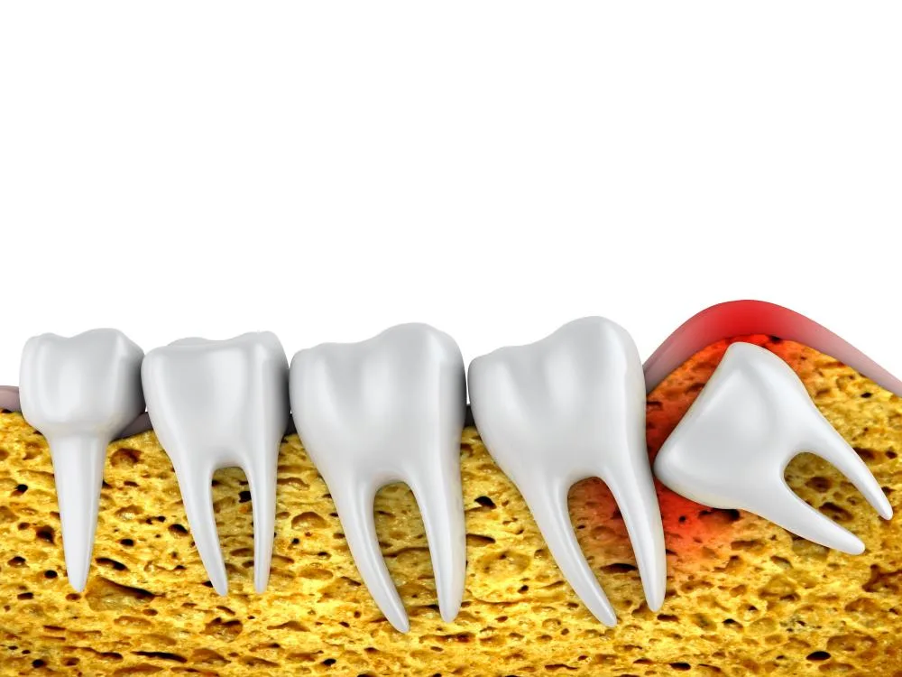 dry socket symptoms