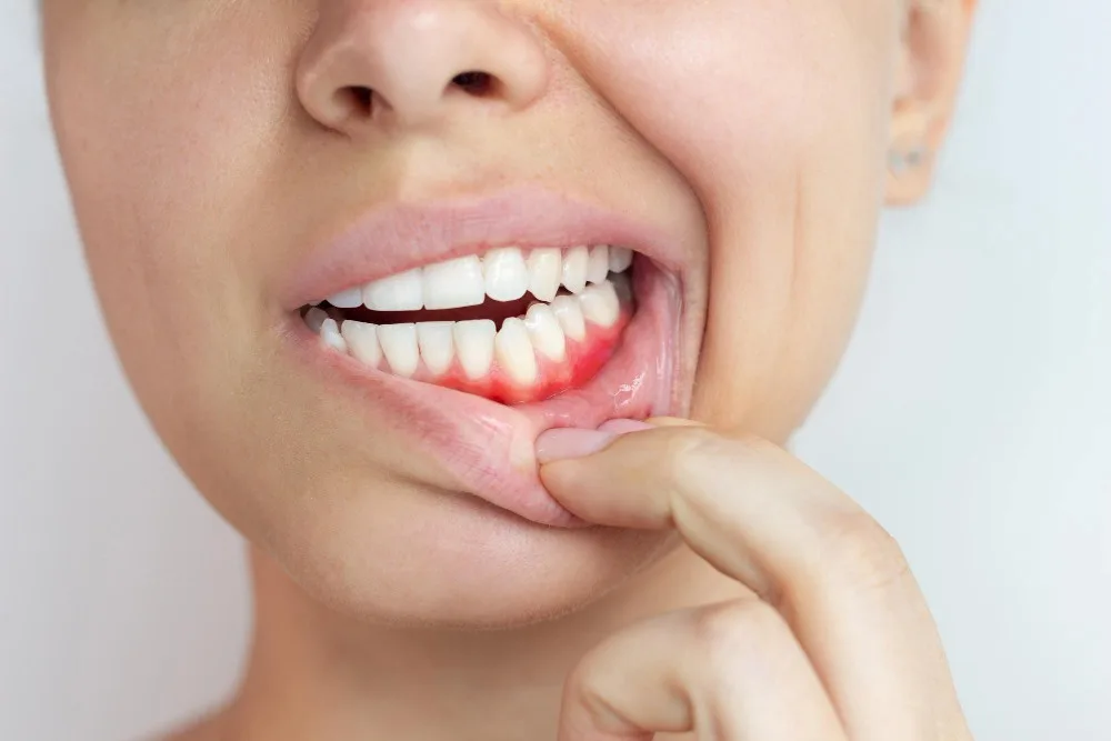 gum cyst