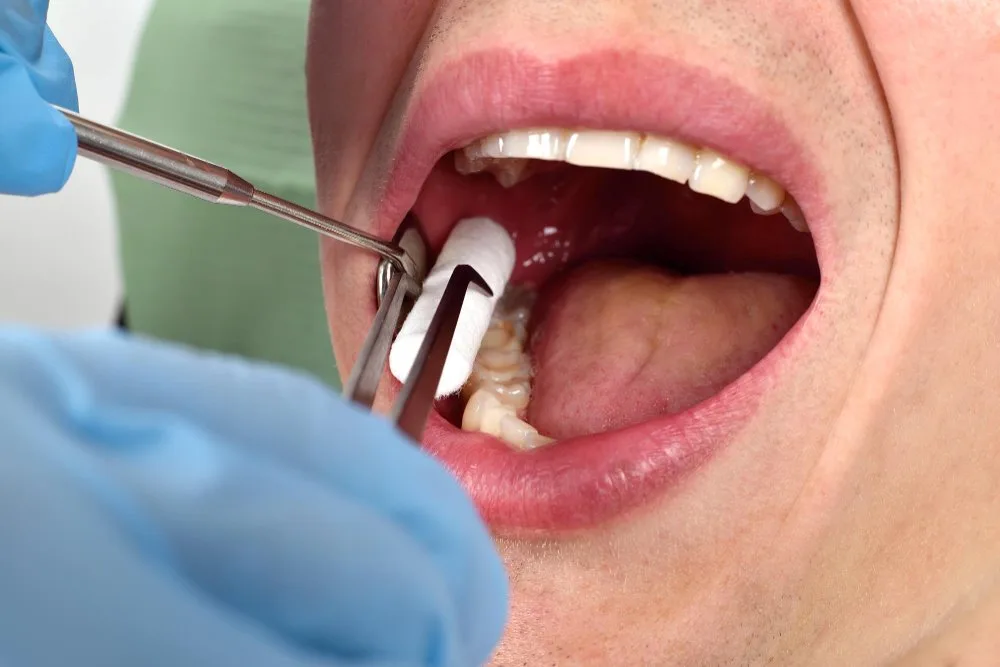 post extraction symptoms